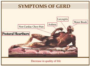 GERD body